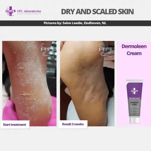 HFL Laboratories Dermoleen kreem 10% uureaga, kuivale nahale - Pilt 9