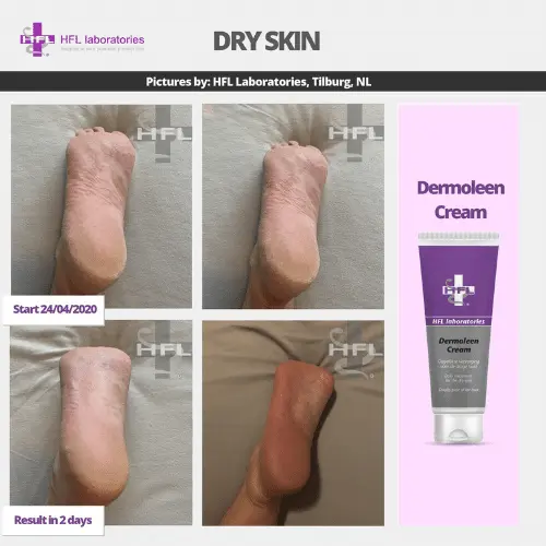 HFL Laboratories Dermoleen kreem 10% uureaga, kuivale nahale - Pilt 8