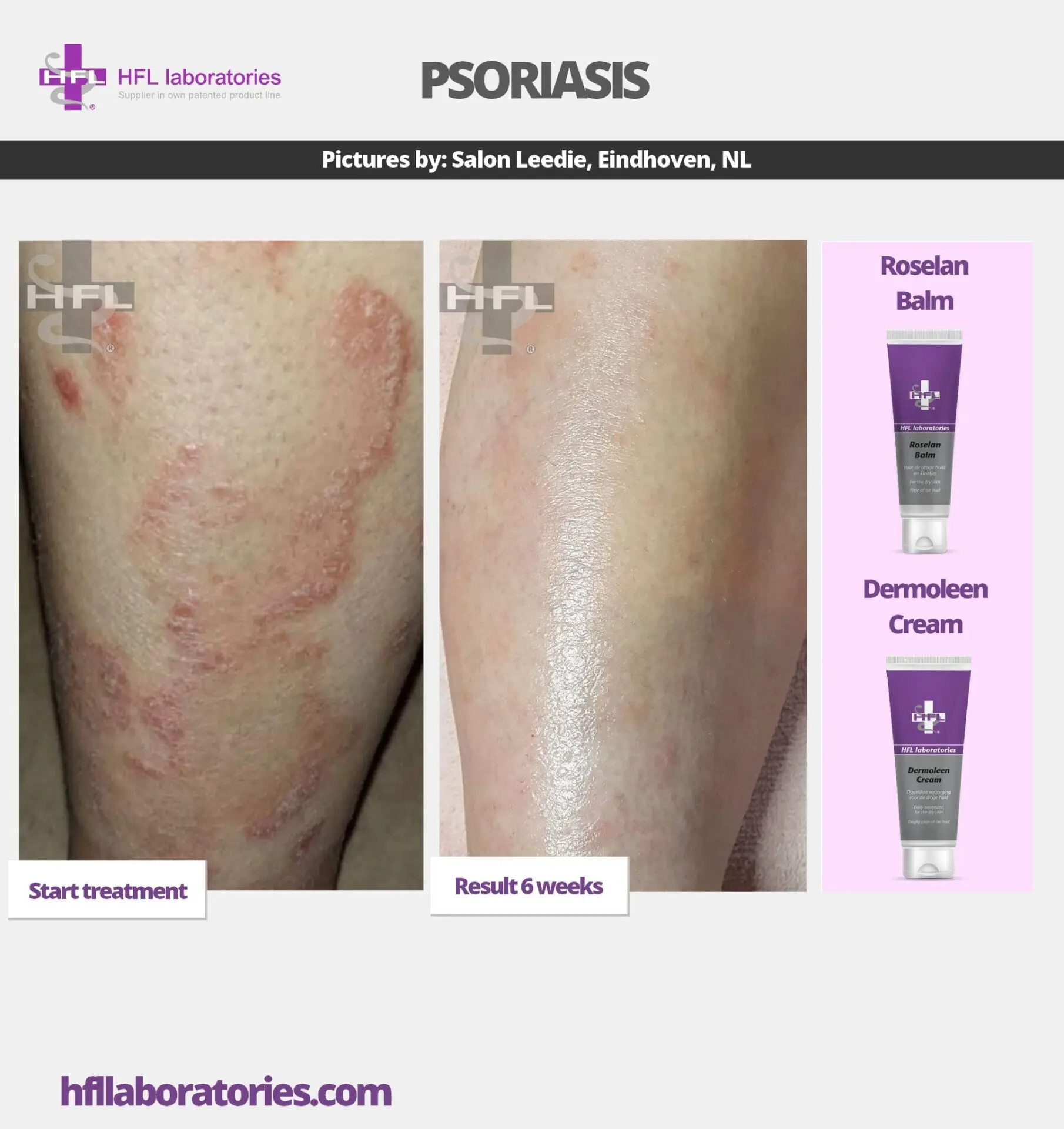 HFL Laboratories Dermoleen kreem 10% uureaga, kuivale nahale - Pilt 3
