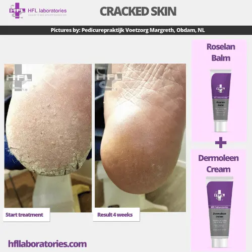 HFL Laboratories Dermoleen kreem 10% uureaga, kuivale nahale - Pilt 7