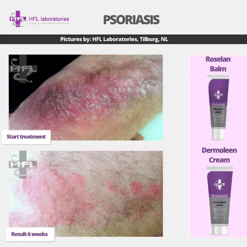 HFL Laboratories Dermoleen kreem 10% uureaga, kuivale nahale - Pilt 6