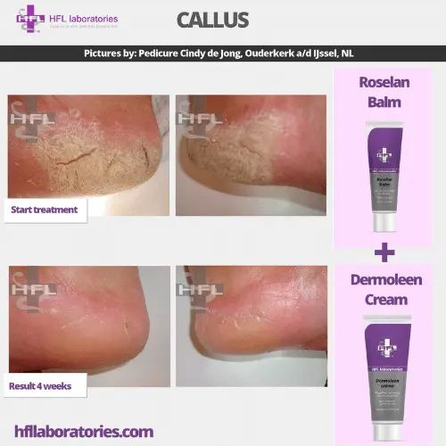 HFL Laboratories Dermoleen kreem 10% uureaga, kuivale nahale - Pilt 4